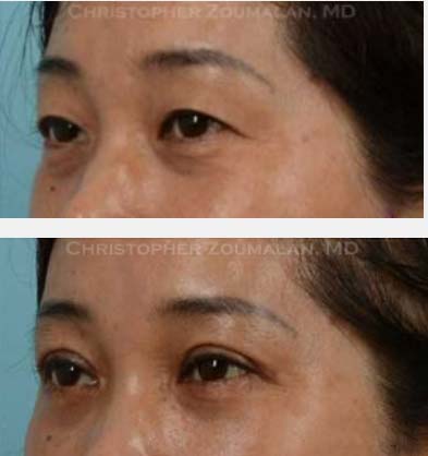 All About Eyelid Surgery Cost and Procedure - Texas Eye and Cataract