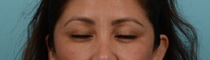 TOP-zoumalan-upper-eyelid-patient-1