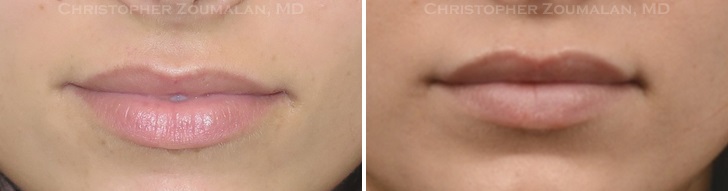 Lip-augmentation-Patient-5-before