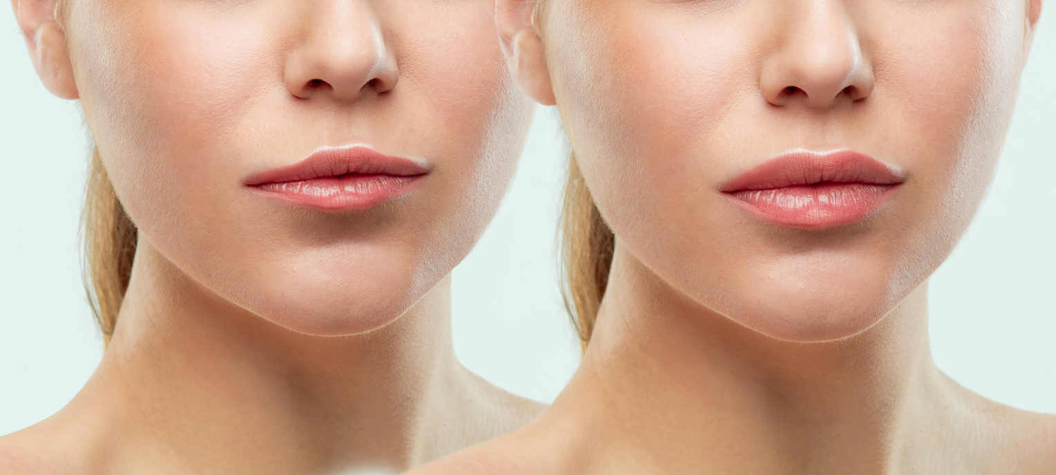 Lip Filler Aftercare: What Not to Do for Optimal Results