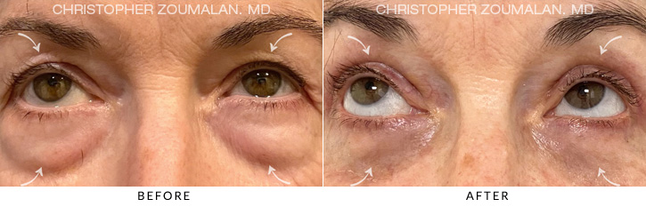Quad Blepharoplasty Before & After Photo - Patient Seeing Up - Patient 5B