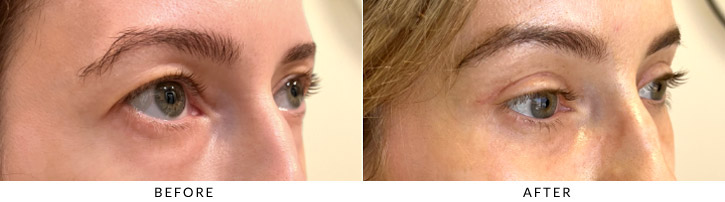 Lower Lid Blepharoplasty Before & After Photo - Patient Seeing Side - Patient 4C