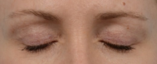 How do Eyelid Scars Heal Before & After Photo - Upper Eyelid Blepharoplasty & Quad Blepharoplasty - Patient 4