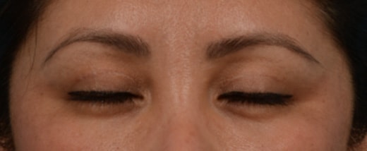 How do Eyelid Scars Heal Before & After Photo - Upper Eyelid Blepharoplasty & Quad Blepharoplasty - Patient 3