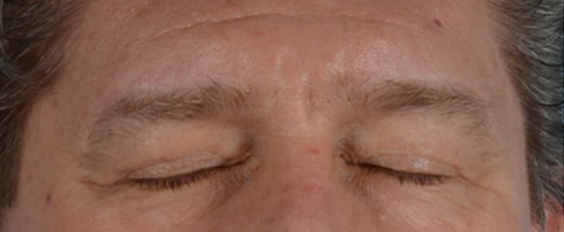 How do Eyelid Scars Heal Before & After Photo - Male Blepharoplasty - Patient 2