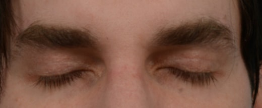 How do Eyelid Scars Heal Before & After Photo - Male Blepharoplasty - Patient 1