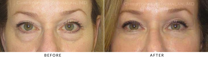 Undereye Fillers  Facial Sculpting