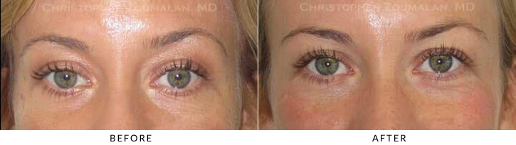 Eye Bags Can Look Worse When Treated With Filler – Here's Why