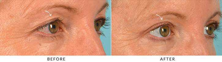 Asian Eyelid (Double Eyelid) Surgery Before & After Photo - Patient Seeing Side - Patient 2B