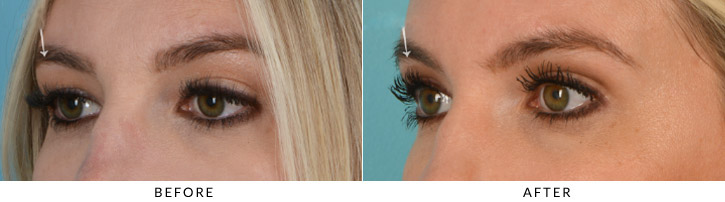 Upper Lid Blepharoplasty Before & After Photo - Patient Seeing Side - Patient 3C