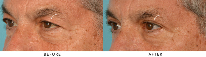Upper Lid Blepharoplasty Before & After Photo - Patient Seeing Side - Patient 4D