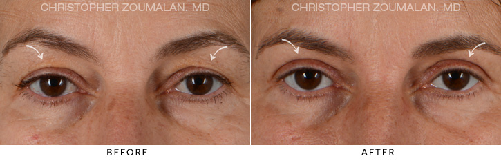 Upper Lid Blepharoplasty Before & After Photo - Patient Seeing Straight - Patient 12A