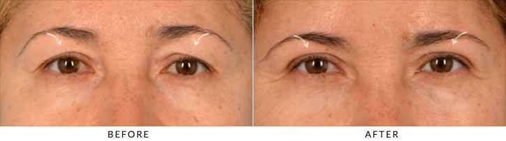 Upper Lid Blepharoplasty Before & After Photo - Patient Seeing Straight - Patient 1B
