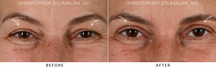 Upper Lid Blepharoplasty Before & After Photo - Patient Seeing Straight - Patient 6B