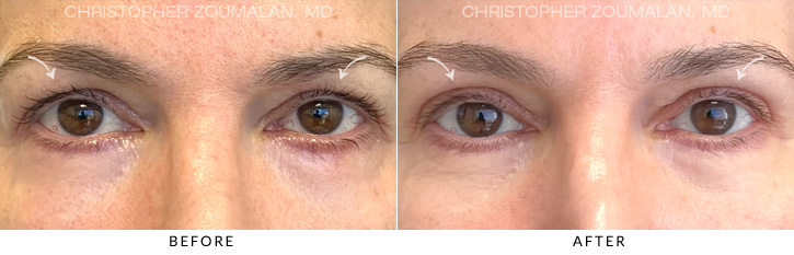 Upper Lid Blepharoplasty Before & After Photo - Patient Seeing Straight - Patient 8