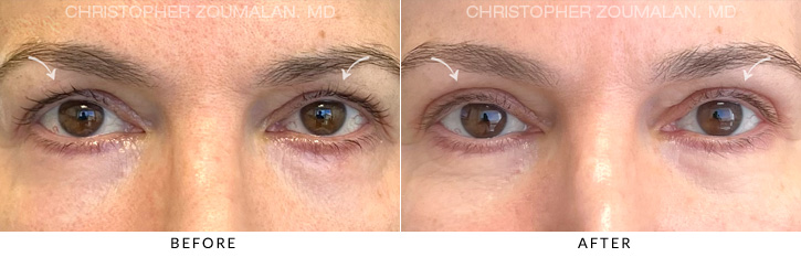 Upper Lid Blepharoplasty Before & After Photo - Patient Seeing Straight - Patient 14