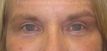 Combining Cosmetic Eyelid Fillers