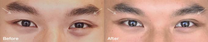 Asian eyelid surgery upper eyelids 1