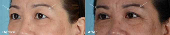 Asian eyelid surgery upper eyelids 2