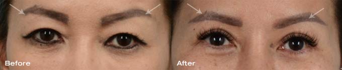 Asian eyelid surgery upper eyelids 3