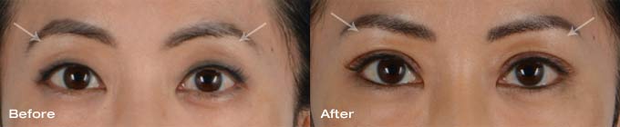 Asian eyelid surgery upper eyelids