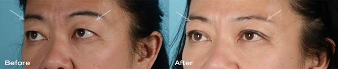 Asian eyelid surgery upper eyelids