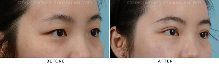 Asian Eyelid (Double Eyelid) Surgery Before & After Photo - Patient Seeing Side - Patient 12A