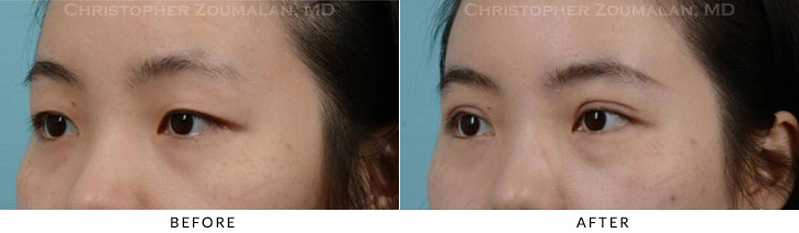 Asian Eyelid (Double Eyelid) Surgery Before & After Photo - Patient Seeing Side - Patient 12B