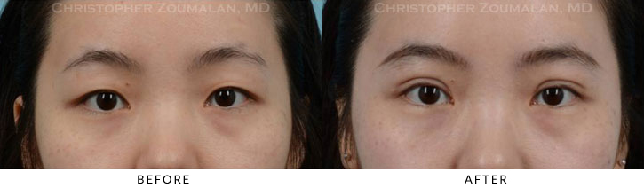 Asian Eyelid (Double Eyelid) Surgery Before & After Photo - Patient Seeing Straight - Patient 12C