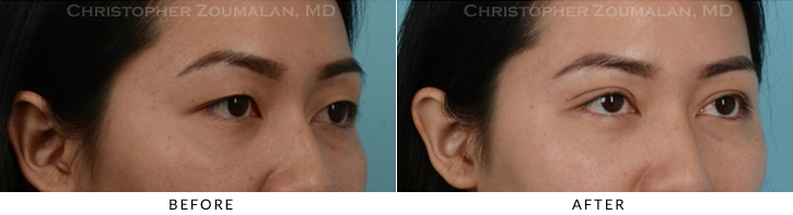 Asian Eyelid (Double Eyelid) Surgery Before & After Photo - Patient Seeing Side - Patient 13A