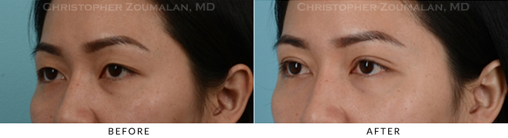 Asian Eyelid (Double Eyelid) Surgery Before & After Photo - Patient Seeing Side - Patient 13B
