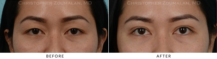Asian Eyelid (Double Eyelid) Surgery Before & After Photo - Patient Seeing Straight - Patient 13C