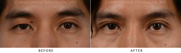 Asian Eyelid (Double Eyelid) Surgery Before & After Photo -  - Patient 14