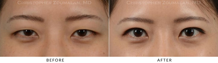 Asian Eyelid (Double Eyelid) Surgery Before & After Photo -  - Patient 15