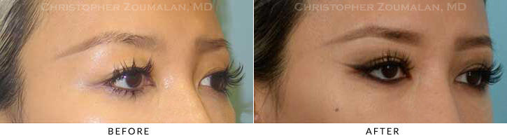 Asian Eyelid (Double Eyelid) Surgery Before & After Photo - Patient Seeing Side - Patient 16A