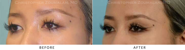 Asian Eyelid (Double Eyelid) Surgery Before & After Photo - Patient Seeing Side - Patient 16B