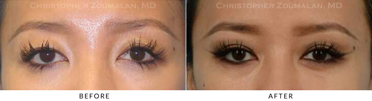 Asian Eyelid (Double Eyelid) Surgery Before & After Photo - Patient Seeing Straight - Patient 14C