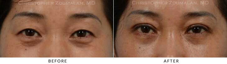 Asian Eyelid (Double Eyelid) Surgery Before & After Photo - Patient Seeing Straight - Patient 17A