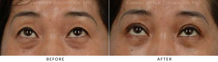 Asian Eyelid (Double Eyelid) Surgery Before & After Photo - Patient Seeing Up - Patient 17B
