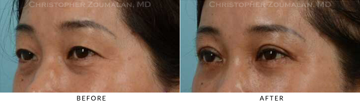 Asian Eyelid (Double Eyelid) Surgery Before & After Photo - Patient Seeing Side - Patient 17C