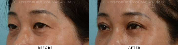Asian Eyelid (Double Eyelid) Surgery Before & After Photo - Patient Seeing Side - Patient 15C