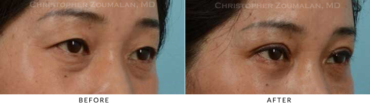 Asian Eyelid (Double Eyelid) Surgery Before & After Photo - Patient Seeing Side - Patient 15D