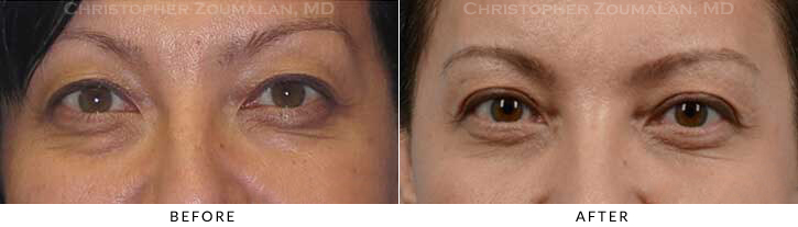 Asian Eyelid (Double Eyelid) Surgery Before & After Photo - Patient Seeing Straight - Patient 18A