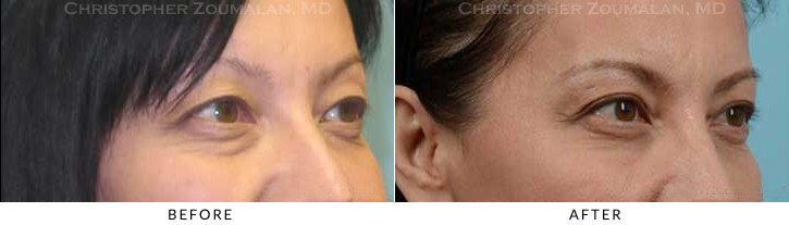 Asian Eyelid (Double Eyelid) Surgery Before & After Photo - Patient Seeing Side - Patient 16B