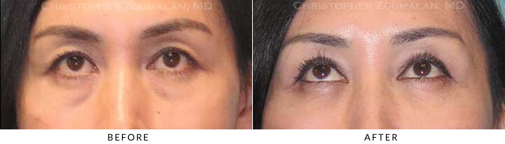 Asian Eyelid (Double Eyelid) Surgery Before & After Photo - Patient Seeing Up - Patient 19A