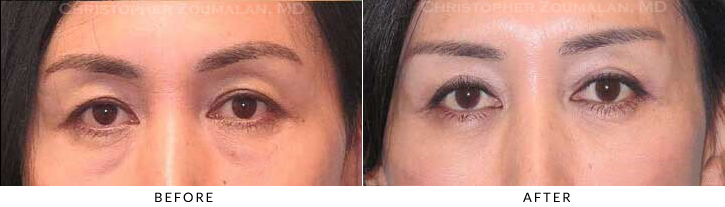 Asian Eyelid (Double Eyelid) Surgery Before & After Photo - Patient Seeing Straight - Patient 19C