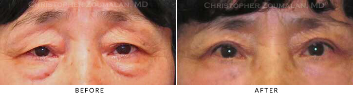 Asian Eyelid (Double Eyelid) Surgery Before & After Photo - Patient Seeing Straight - Patient 20B