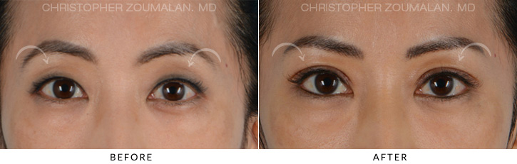 Asian Eyelid (Double Eyelid) Surgery Before & After Photo - Patient Seeing Straight - Patient 3A