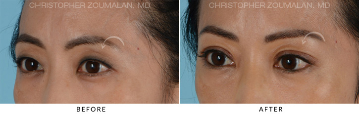 Asian Eyelid (Double Eyelid) Surgery Before & After Photo - Patient Seeing Side - Patient 3B