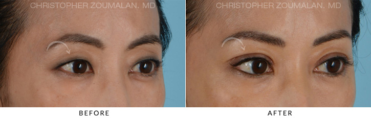Asian Eyelid (Double Eyelid) Surgery Before & After Photo - Patient Seeing Side - Patient 3C